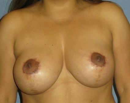 Breast Lift Before & After Patient #1396