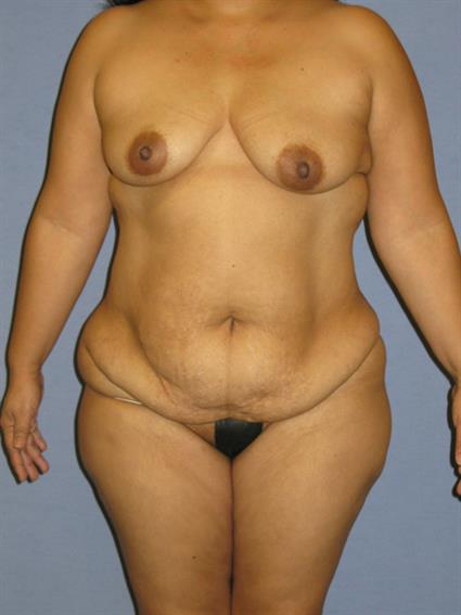 Full Body Lift Before & After Patient #968