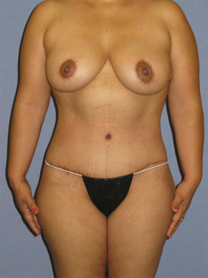 Full Body Lift Before & After Patient #968