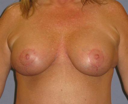 Breast Lift Before & After Patient #1391