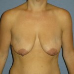 Breast Lift Before & After Patient #1380