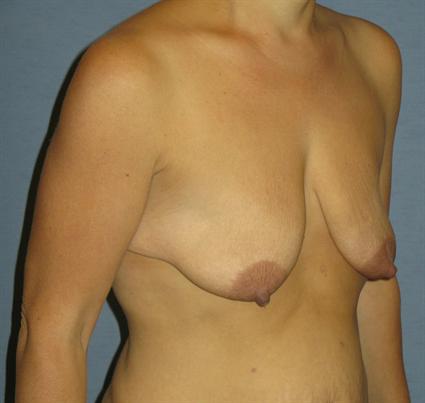 Breast Lift Before & After Patient #1380