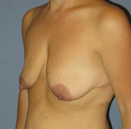 Breast Lift Before & After Patient #1380