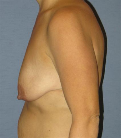 Breast Lift Before & After Patient #1380