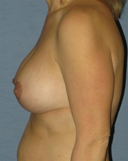 Breast Lift Before & After Patient #1380