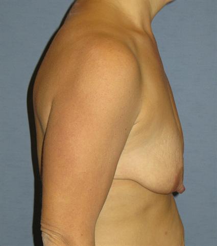 Breast Lift Before & After Patient #1380