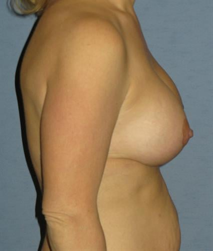 Breast Lift Before & After Patient #1380