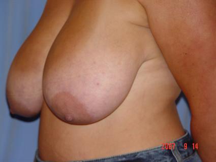 Breast Reduction Before & After Patient #1417