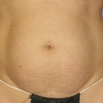 Tummy Tuck Before & After Patient #1094