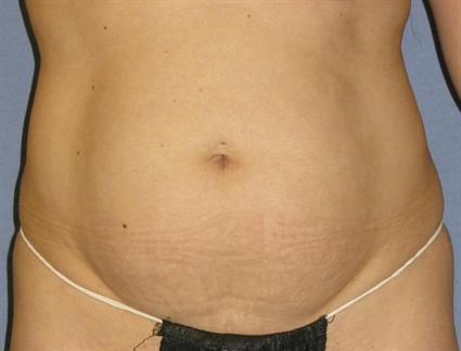 Tummy Tuck Before & After Patient #1094