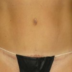 Tummy Tuck Before & After Patient #1094