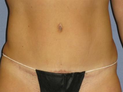 Tummy Tuck Before & After Patient #1094