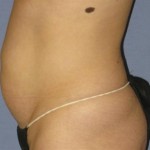 Tummy Tuck Before & After Patient #1094