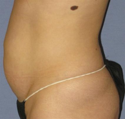 Tummy Tuck Before & After Patient #1094