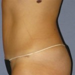 Tummy Tuck Before & After Patient #1094