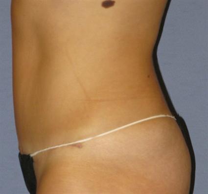 Tummy Tuck Before & After Patient #1094