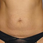 Tummy Tuck Before & After Patient #1170