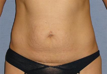 Tummy Tuck Before & After Patient #1170