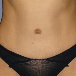 Tummy Tuck Before & After Patient #1170