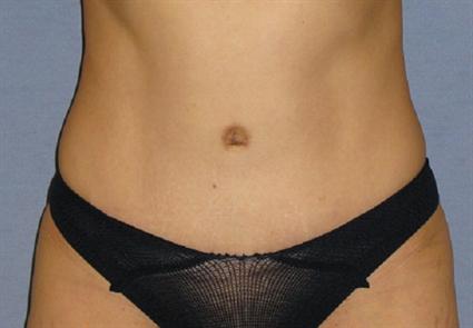 Tummy Tuck Before & After Patient #1170