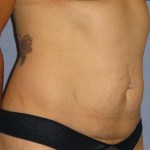 Tummy Tuck Before & After Patient #1170