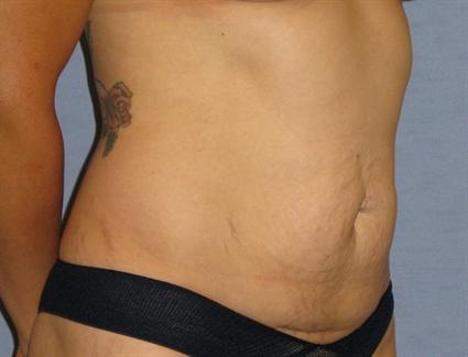 Tummy Tuck Before & After Patient #1170