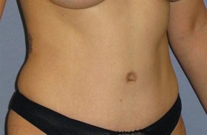 Tummy Tuck Before & After Patient #1170