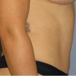 Tummy Tuck Before & After Patient #1170