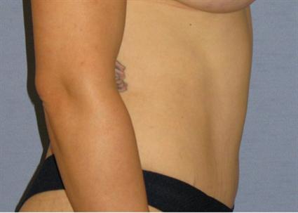 Tummy Tuck Before & After Patient #1170