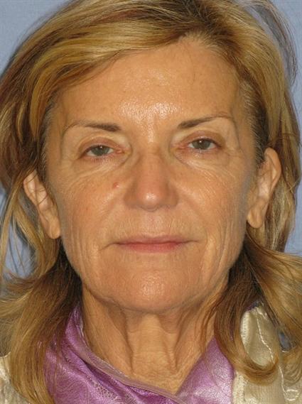 Facelift Before & After Patient #1432