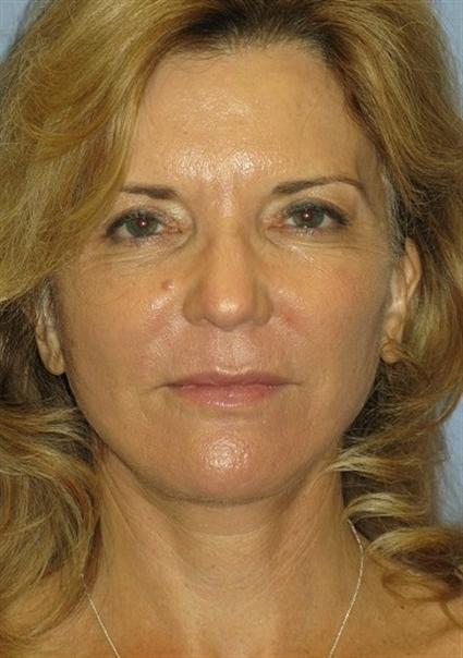 Facelift Before & After Patient #1432