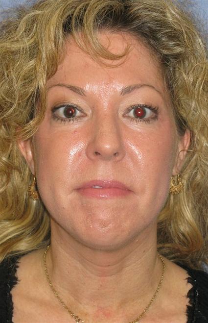 Eyelid Surgery Before & After Patient #1559