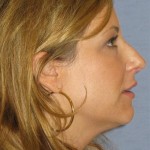 Rhinoplasty Before & After Patient #1776