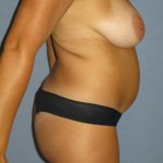 Breast Augmentation Before & After Patient #1063