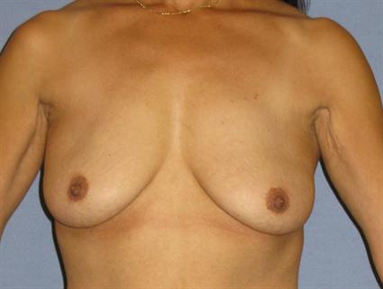 Breast Augmentation Before & After Patient #958