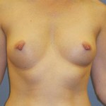 Breast Augmentation Before & After Patient #951