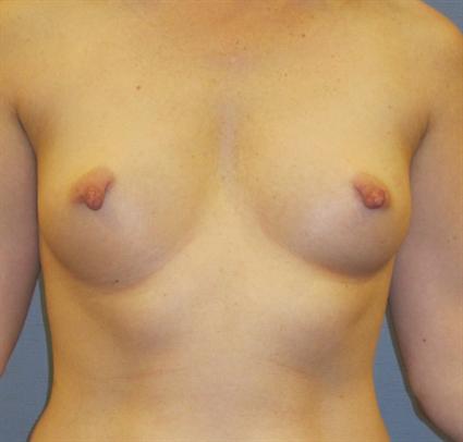 Breast Augmentation Before & After Patient #951