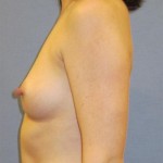 Breast Augmentation Before & After Patient #951