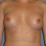 Breast Augmentation Before & After Patient #941