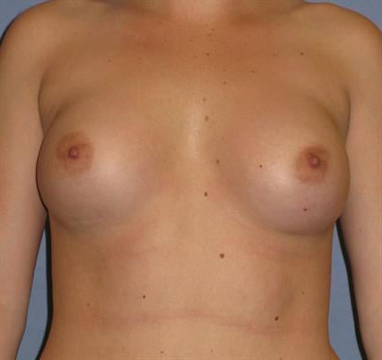 Breast Augmentation Before & After Patient #941