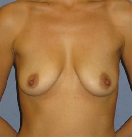 Breast Augmentation Before & After Patient #935