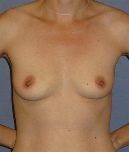 Breast Augmentation Before & After Patient #928