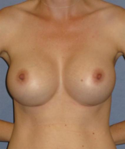 Breast Augmentation Before & After Patient #928