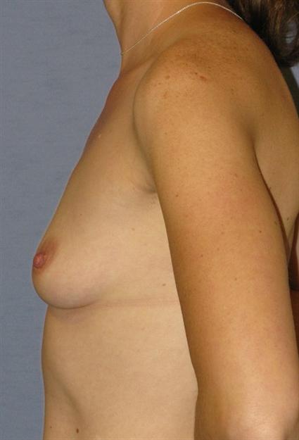 Breast Augmentation Before & After Patient #928