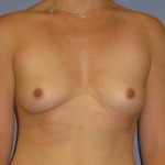 Breast Augmentation Before & After Patient #921