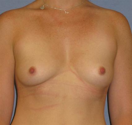 Breast Augmentation Before & After Patient #921