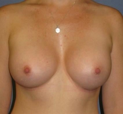 Breast Augmentation Before & After Patient #921