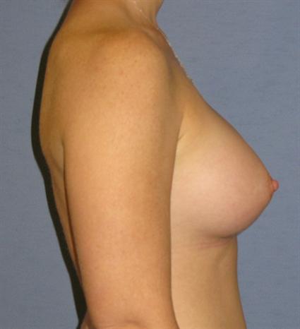 Breast Augmentation Before & After Patient #921