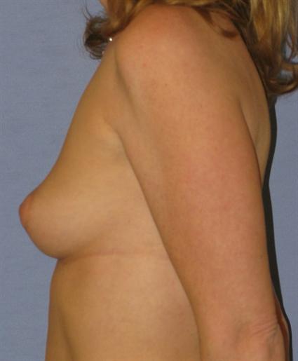Breast Augmentation Before & After Patient #914