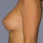 Breast Augmentation Before & After Patient #914